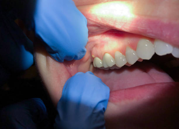 Best Emergency Care for Gum Disease in Diamond Bar, CA