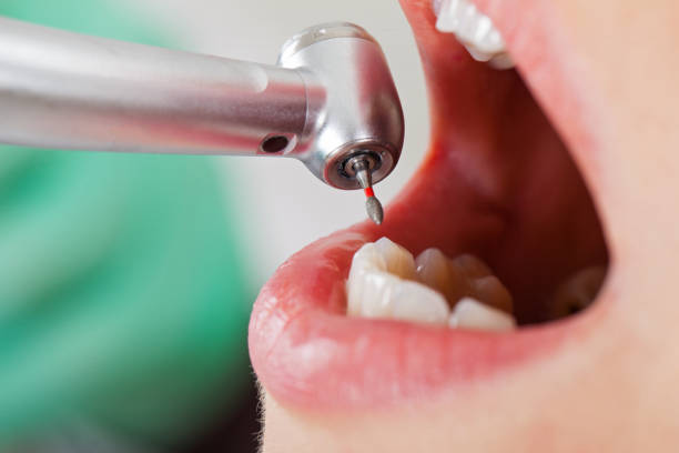 Best Lost Filling or Crown Replacement in Diamond Bar, CA